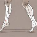 Compression stockings on a pair of legs with visible veins to signify poor circulation