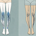 Compression stockings next to a pair of normal legs with visible varicose veins