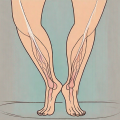 A pair of legs with visible signs of lipedema such as disproportionate swelling